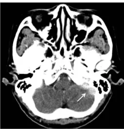 Fig. 1. Preoperative CT scan shows a 2.2×1.6cm homogenous enhancing mass(arrow) in left parapharyngeal space with  medi-al deviation of left ICA
