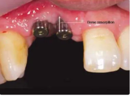 Fig 1 . Exposure of implant platform by missing of soft tissue