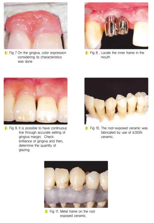 Fig 10. The root-exposed ceramic was fabricated by use of d.SIGN ceramic.