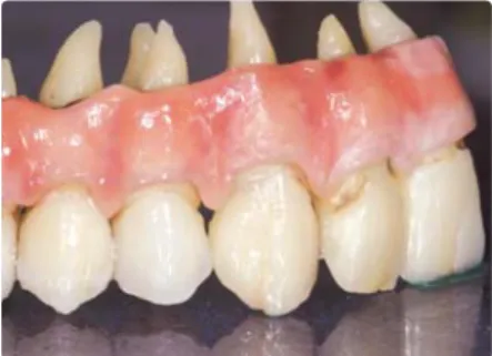 Fig 12. Gingiva powder that is built up on the metal frame