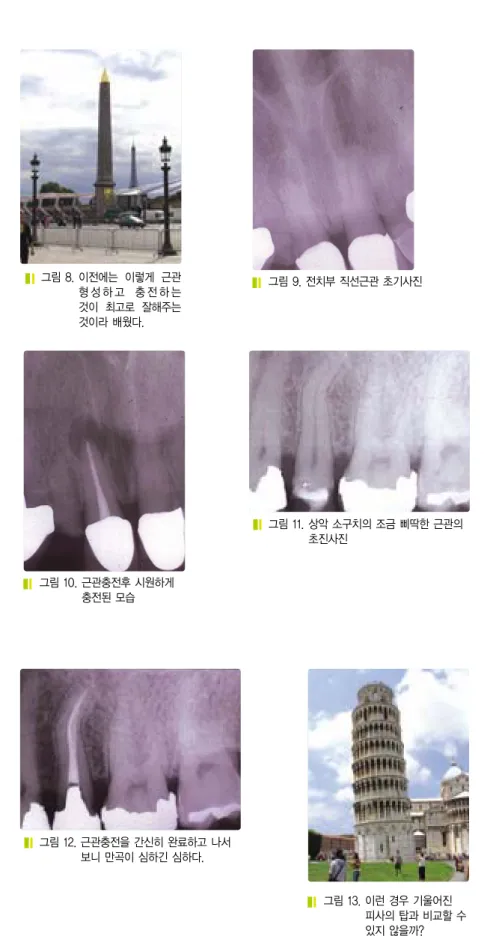그림 12. 근관충전을 간신히 완료하고 나서 보니 만곡이 심하긴 심하다.충전된 모습 그림 13. 이런 경우 기울어진 피사의 탑과 비교할 수 있지 않을까?