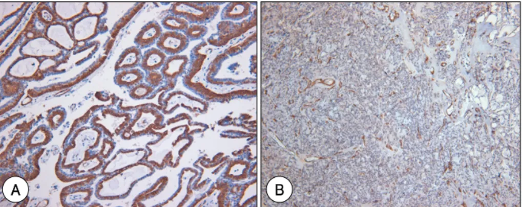 Fig. 3. Pathologic findings with immunostaining of SMA of adenoid cystic carcinoma(A), mucoepidermoid carcinoma(B)