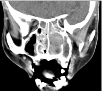 Fig. 1. Paranasal sinus CT shows a mass with heterogeneous low attenuation along with bony remodeling