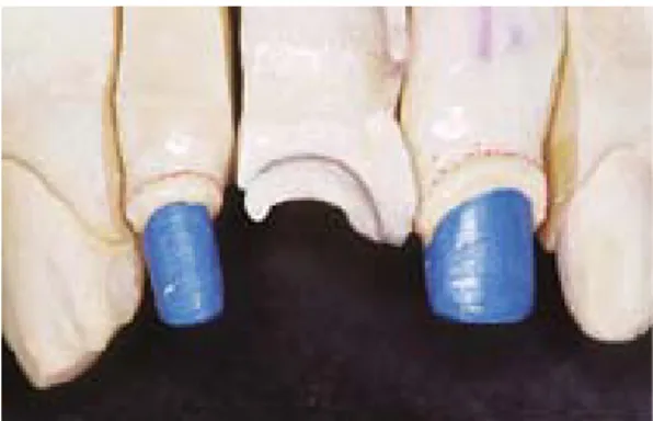 그림 15-4.   임시수복물 가공치 하방에 silicone  adhesive를 도포한 후, 인상재(Exaflex regular body, GC)를 이용하여 조직을 인상한다