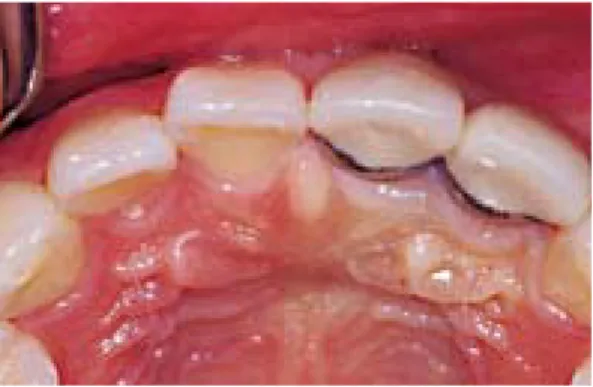 그림 5.  Gingivitis, gingival discoloration, cervical black line, tooth  splinting,  line  angle,  labial  contour,  tooth size,  opacity등 여러 가지 문제점들을 관찰 할 수가 있다