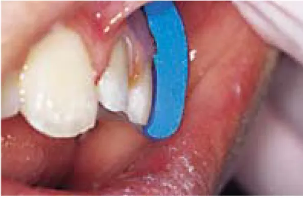 그림 7.  PLV의 삭 제 량 도 충 분 한 지 확 인 한 다 (Labial  - -0.3~0.5mm, Incisal - 상악; 교합에 견딜 수 있는 두 께로, 하악; Minimum 1.5mm)