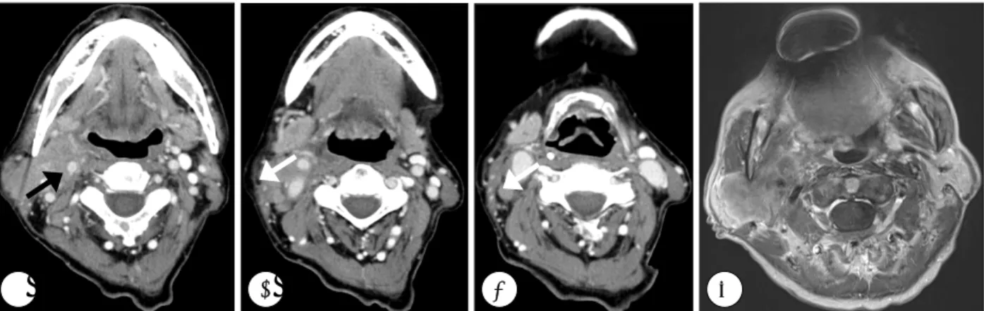 Fig. 1. Preoperative axial CT scans and MRI. CT scans show a relatively homogenous enhanced parotid mass enclosing a external carotid artery(black arrow) and multiple metastatic lymph nodes with extracapsular spread at level II and III(white  arrow)(A-C)