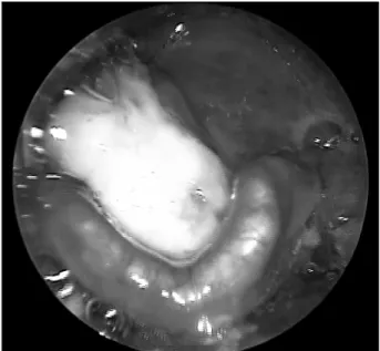 Fig. 2. Axial(A) and coronal(B) CT scan show well-defined heter- heter-ogeneous enhancing soft tissue mass with broad base at right aryepiglottic fold