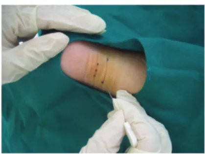 Fig. 1- ③.   A, B measuring  depth of acupoint by probe needle and gauging the insertion length