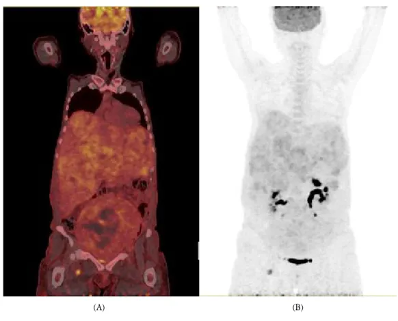 Figure  1.  Patient’s  PET-CT  image