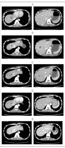 Figure  1.  Comparison  of  abdomen  computed  tomography A  :  Multiple  low  density  hepatic  mastasis  (2018/05)