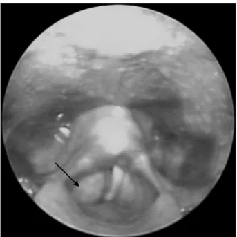 Fig. 2. CT scan of larynx shows a well-circumscribed, cyst-like mass in the area of the right paraglottic space(arrow)