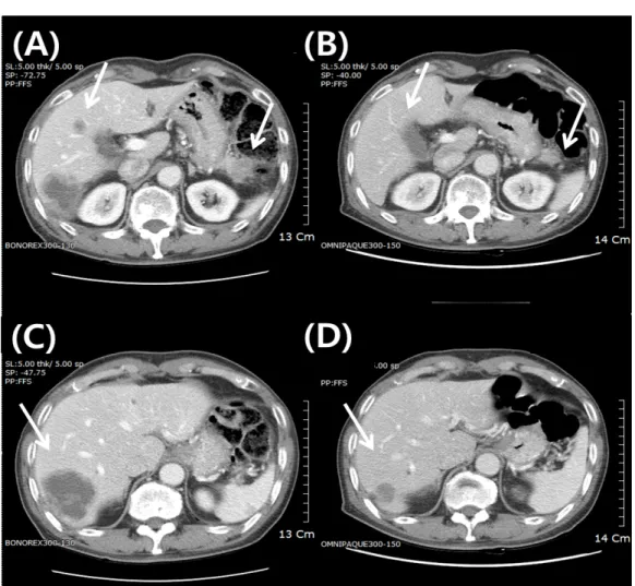 Figure  1.  Computed  tomography  image  (A,  B)  Tumor  masses  in  pancreas  and  liver  on  2016-09-27  and  2017-10-10