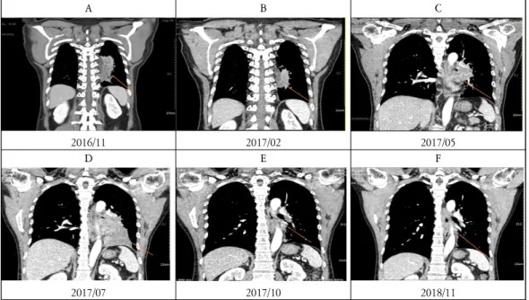Figure  1b.  Comparison  of  chest  computed  tomography