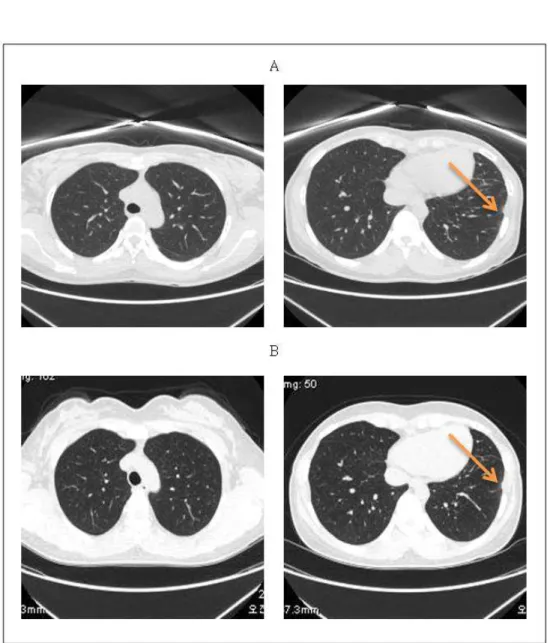 Figure  1.  Comparison  of  chest  computed  tomography