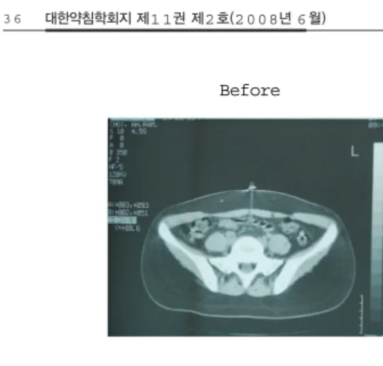 Fig. 4. The change of thickness of fat layer treated with Sweet Bee Venom for 20 times by the
