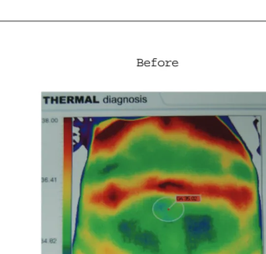 Fig. 4. The change of thickness of fat layer treated with Sweet Bee Venom for 20 times by the