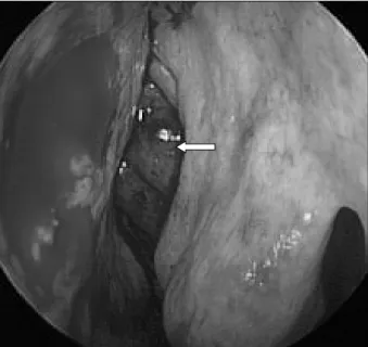 Fig. 3. Intraoperative endoscopic finding：dark-red mass is seen in nasal cavity(white arrow)