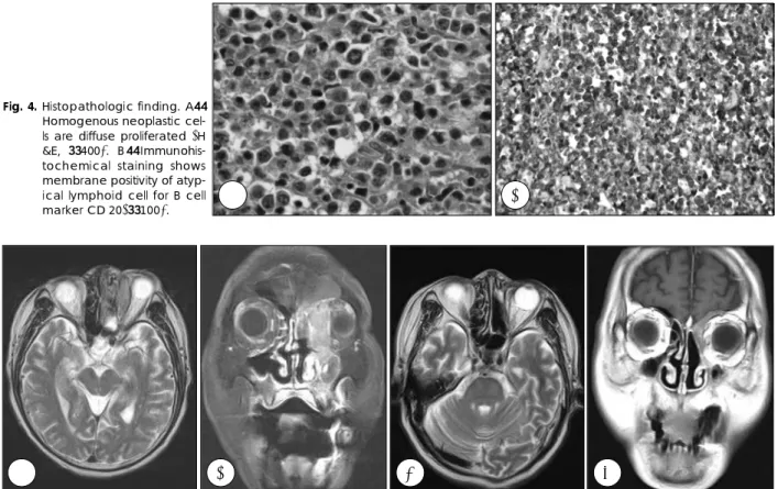 Fig. 5. A, B：Prechemotherapy MRI finding. The homogeneous signal lesion in seen on ethmoid sinus and orbit