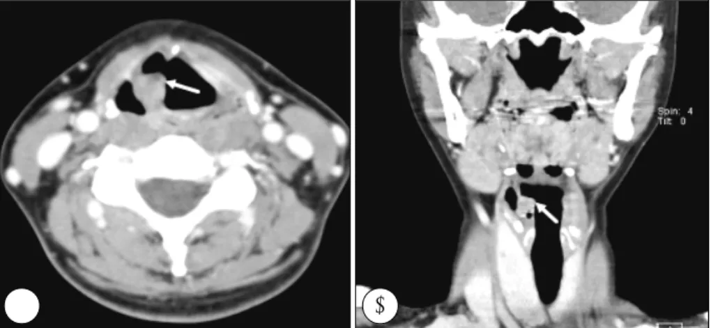 Fig. 3. The microscopic view of the laryngeal mass shows chara- chara-cteristic cribriform pattern of adenoid cystic carcinoma  (H&amp;E, original magnification×400)