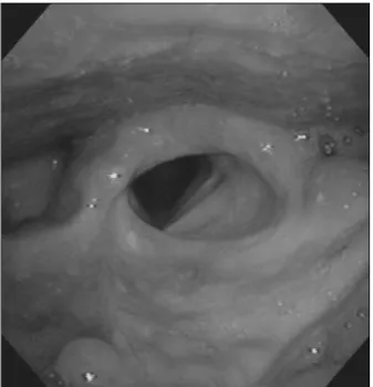 Fig. 4. The fiberoptic laryngoscopic view 2 years after surgery：