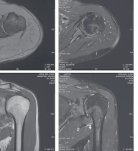 Fig. 2. 2011-10-17 Lt. shoulder MRI