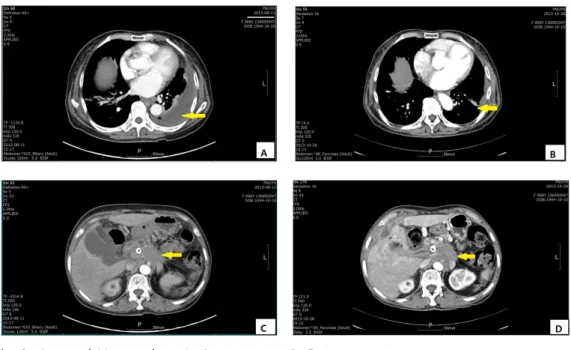 Fig. 3. Computed Tomography : A, C (2013.8.11) B, D (2013.10.28)