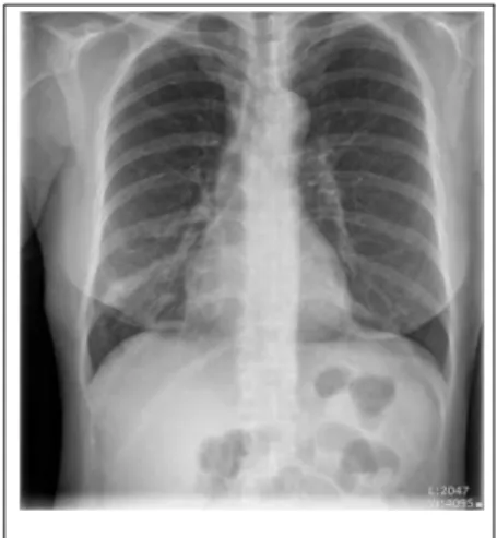 Fig. 1. Chest X-ray on admission day