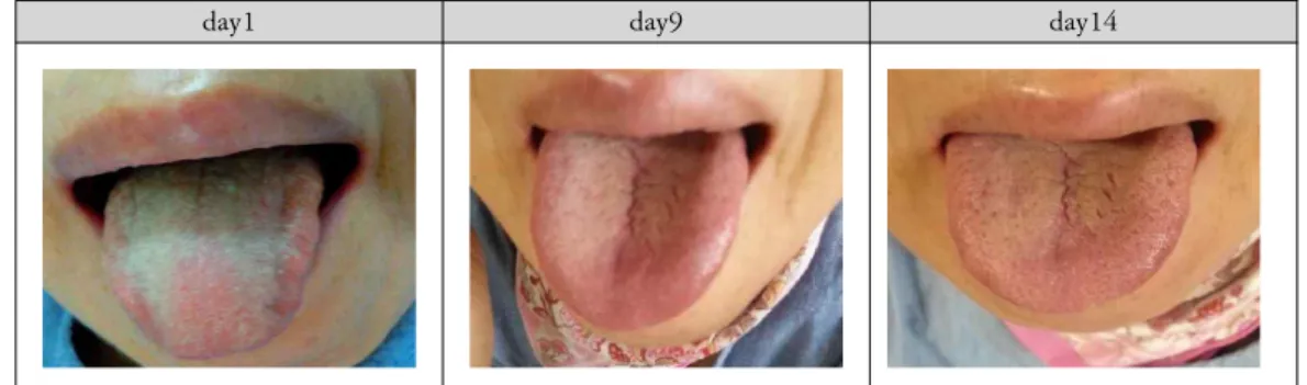 Fig. 3. The serial changes of tongue coat taken on day 1, 9, 14.