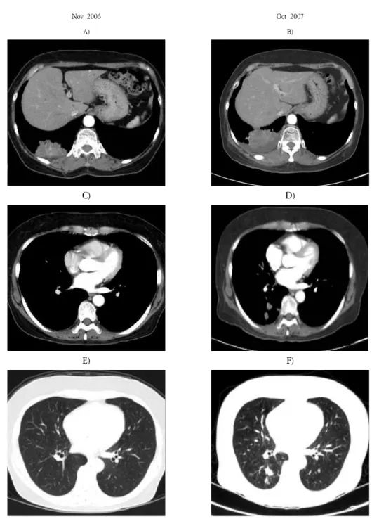 Fig 1. Imaging of patient. A),C),E): computed tomography(CT) at first visit(Nov 2006)