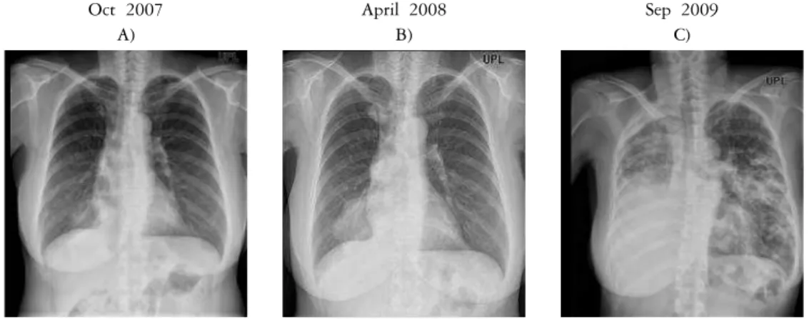 Fig. 2. Image of patient. These figures are chest X-rays : A) : chest X-ray at revisit (Oct 2007)