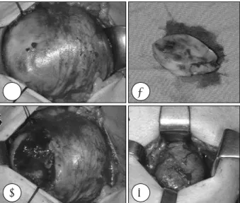 Fig. 4. Whole body PET-CT. A：Huge hypermetabolic mass(pSUV 12.11) consistent with malignant lesion in the right lobe of thyroid, with extension to the left lobe