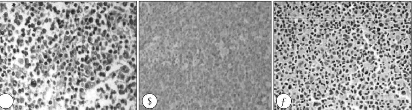 Fig. 6. Histopathologic findings. A：High power microscopic finding of the thyroid mass shows diffuse infiltration of monotonous lym- lym-phocytes with round vesicular nuclei, prominant nucleoli and moderate amount of eosinophilic cytoplasm(H-E stain,  ×400