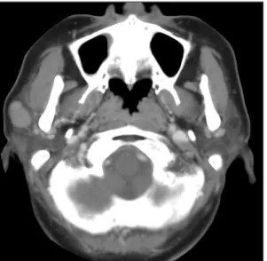 Fig. 1. Preoperative enhanced neck CT scan axial view. It shows well-defined margin ovoid mass with homogeneous  atte-nuation