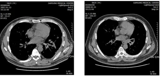 Fig. 2. Chest CT of the patient (case I). Extent of multifocal metastatic nodules in LLL and left pleural effusion decreased .