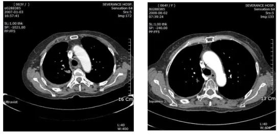Fig. 4. Chest CT of the patient (case II). No remarkable change of residual lung cancer of RS2 and malignant pleural effusion.