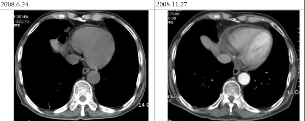 Fig. 1. Chest CT. Newly developed small amount of the pericardial effusion