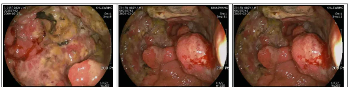 Fig. 1. EGD on March 27, 2009.