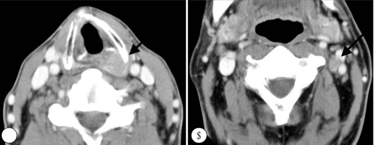 Fig. 2. Preoperative axial CT scan. It shows about 2×3cm enhanced mass in left pyriform sinus(A) and 1×1cm sized mass that is suspected as lymphatic metastasis in level II area(B)