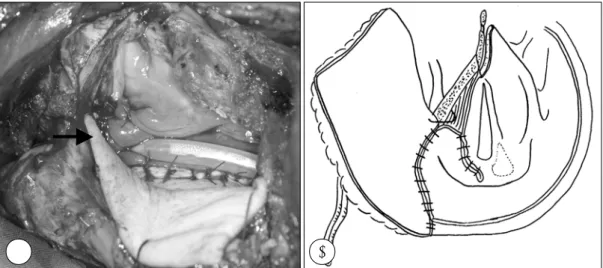 Fig. 5. Post-operative endoscopic view. It shows well attached forearm free flap without recurrence in post-radiation 