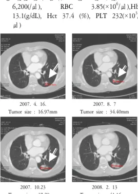 Fig.  1.  Slight  increased  in  size  of  nodule  in  left  lower  lung  superior  segment