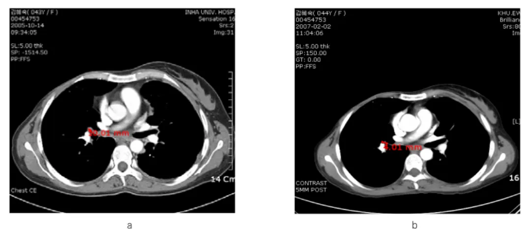 Fig.  1.  Chest  CT  Imaging  of  the  patient.  The  size  of  mass  decreased  after  ARV  intake