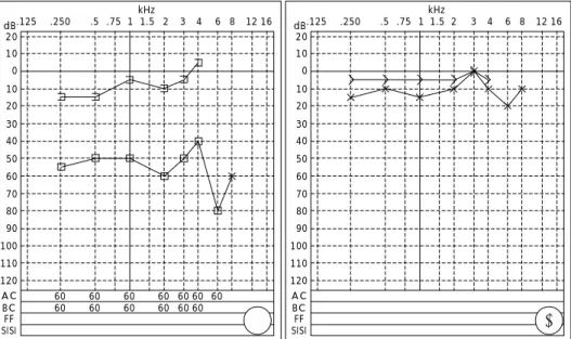 Fig. 5. Pure tone audiometry shows left conductive hearing loss at first visit(A), and remarkable improvement of hearing loss following 1 month later after operation(B)