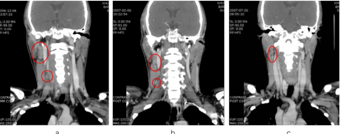 Table  1.  Change  of  tumor  size