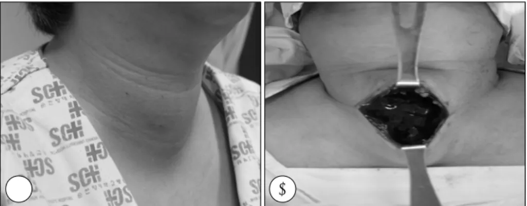 Fig. 3. Microscopic  photograph. Note that there is massive he- he-matomas in thyroid parenchyme(H-E,  ×200)