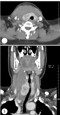 Fig. 5. Case 2. A：Axial image of neck CT scan. Heterogenous solid nodule and diffuse hematoma were noted in right thyroid gland