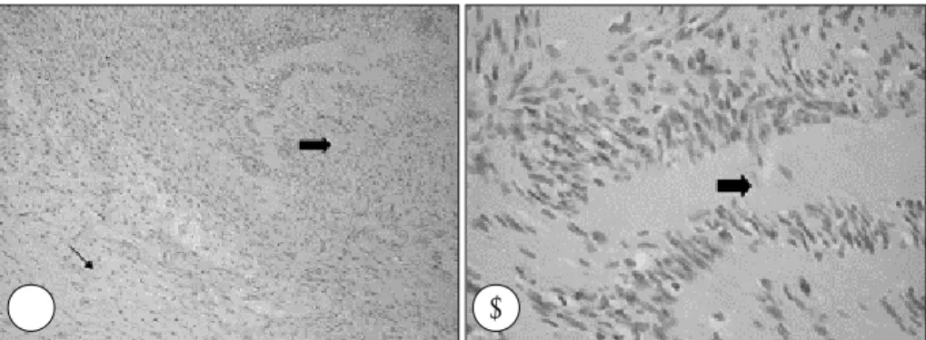Fig. 5. Histopathologic findings. A：Highly cellular Antoni A (bold arrow) and hypocelluar Antoni B (thin arrow)(H-E stain,  ×100)