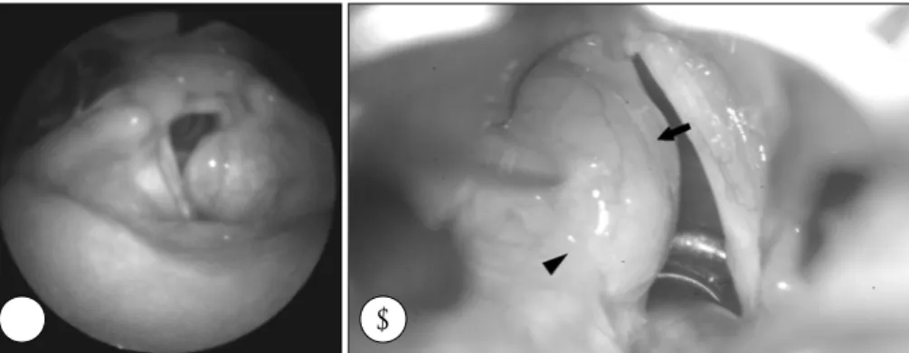 Fig. 1. Rigid laryngoscopic and microlaryngoscopic image. A：Left laryngeal ventricle is filled with the ovoid soft mass