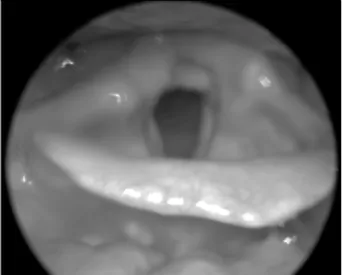 Fig. 6. After the eighteen months of surgery, rigid laryngoscopic finding. Until now there are no evidence of recurrence and mucosal scarring in the vocal fold
