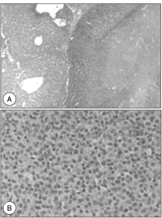 Fig. 2. The tumor is well circumscribed and has nodular growth pattern(H&amp;E,  ×40)(A)